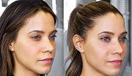 بوتاکس چشم گربه‌ای