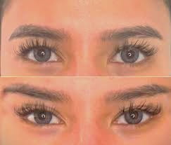 بوتاکس چشم گربه‌ای